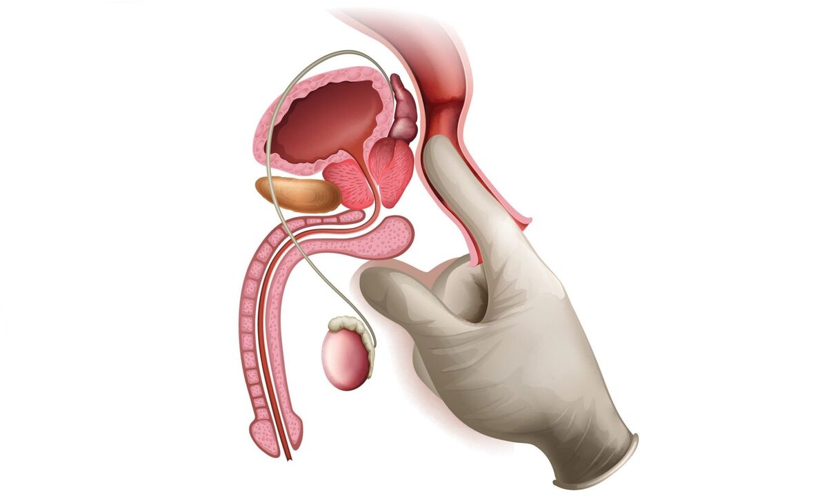 masaxe de próstata para prostatite